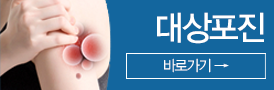 대상포진